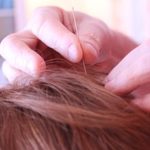 acupuncture