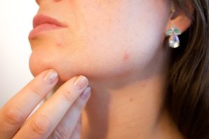 acne around your skin.